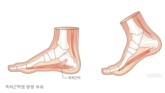 족저근막염 발생부위 알려주는 그림입니다.